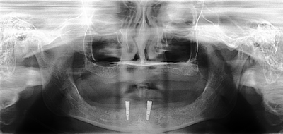 implant dentures 1