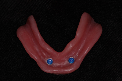 implant dentures 4